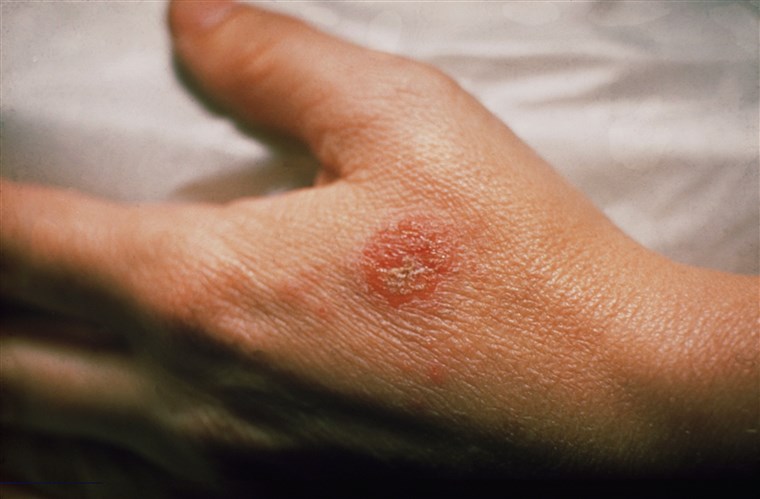Researchers Sheds New Light on Eczema